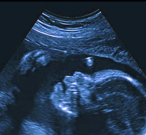 Ultrasound Image