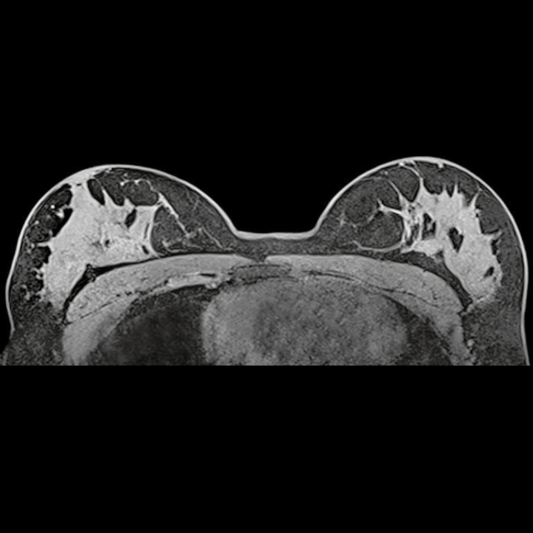 Breast MRI image Breast MRI image